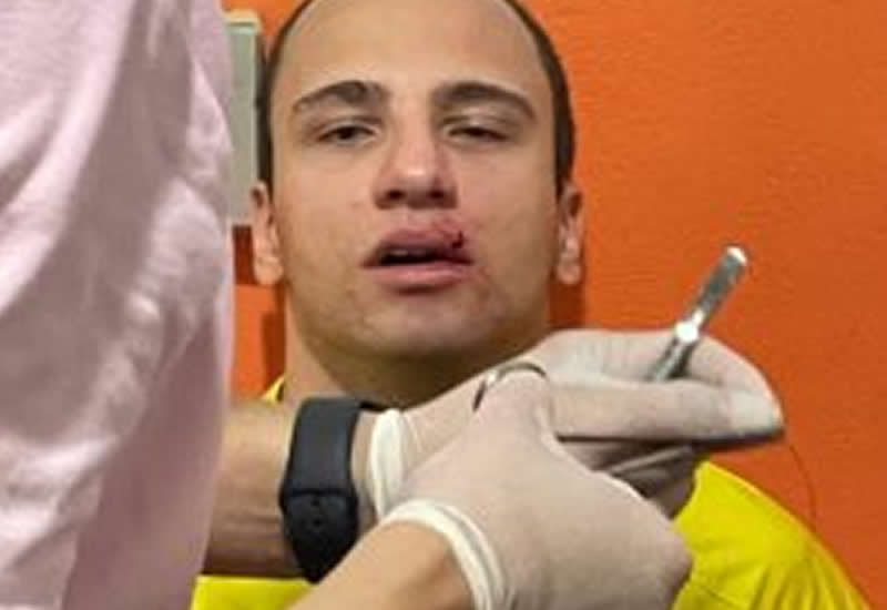 Árbitro assistente sofre agressão e recebe três pontos na boca em partida de MT